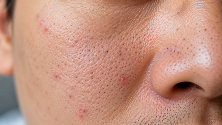 From Skin Concerns to Greater Confidence: Jack’s Bio Young Story